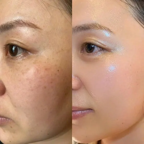 Pigmentation Treatment treatment at Kira Exotica, a beauty salon in Indore